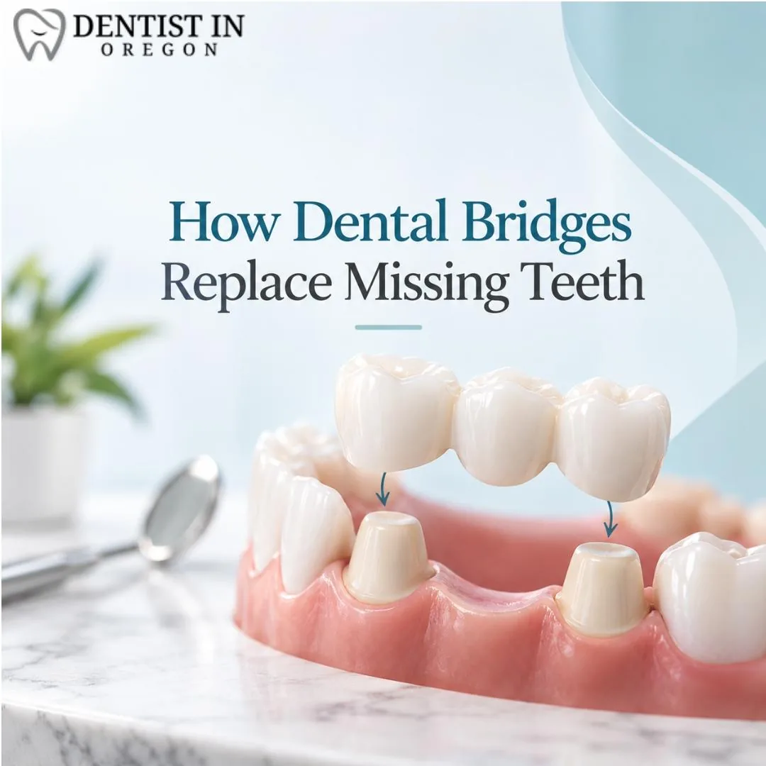 How Dental Bridges Replace Missing Teeth