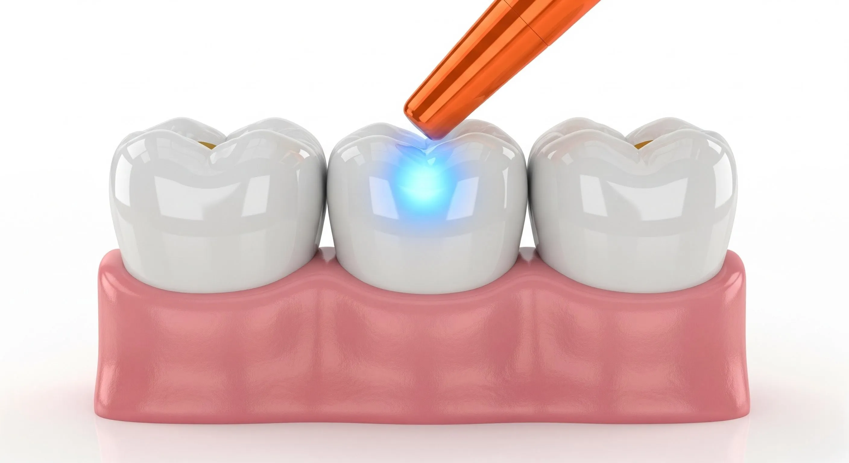 Composite Fillings Cost and Pricing Information in Oregon