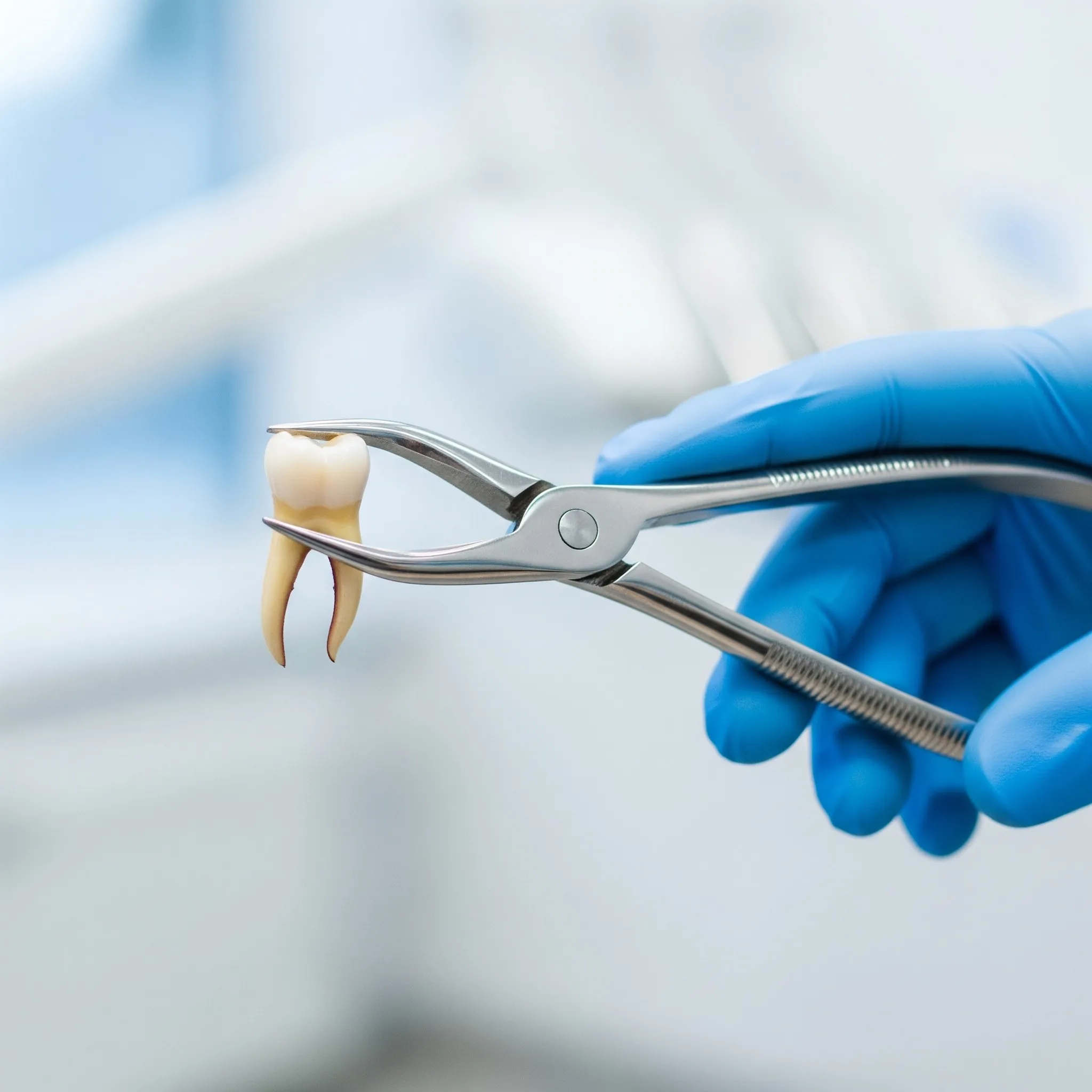 Benefits of Tooth Extractions